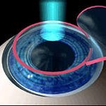 lasik