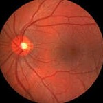 retina
